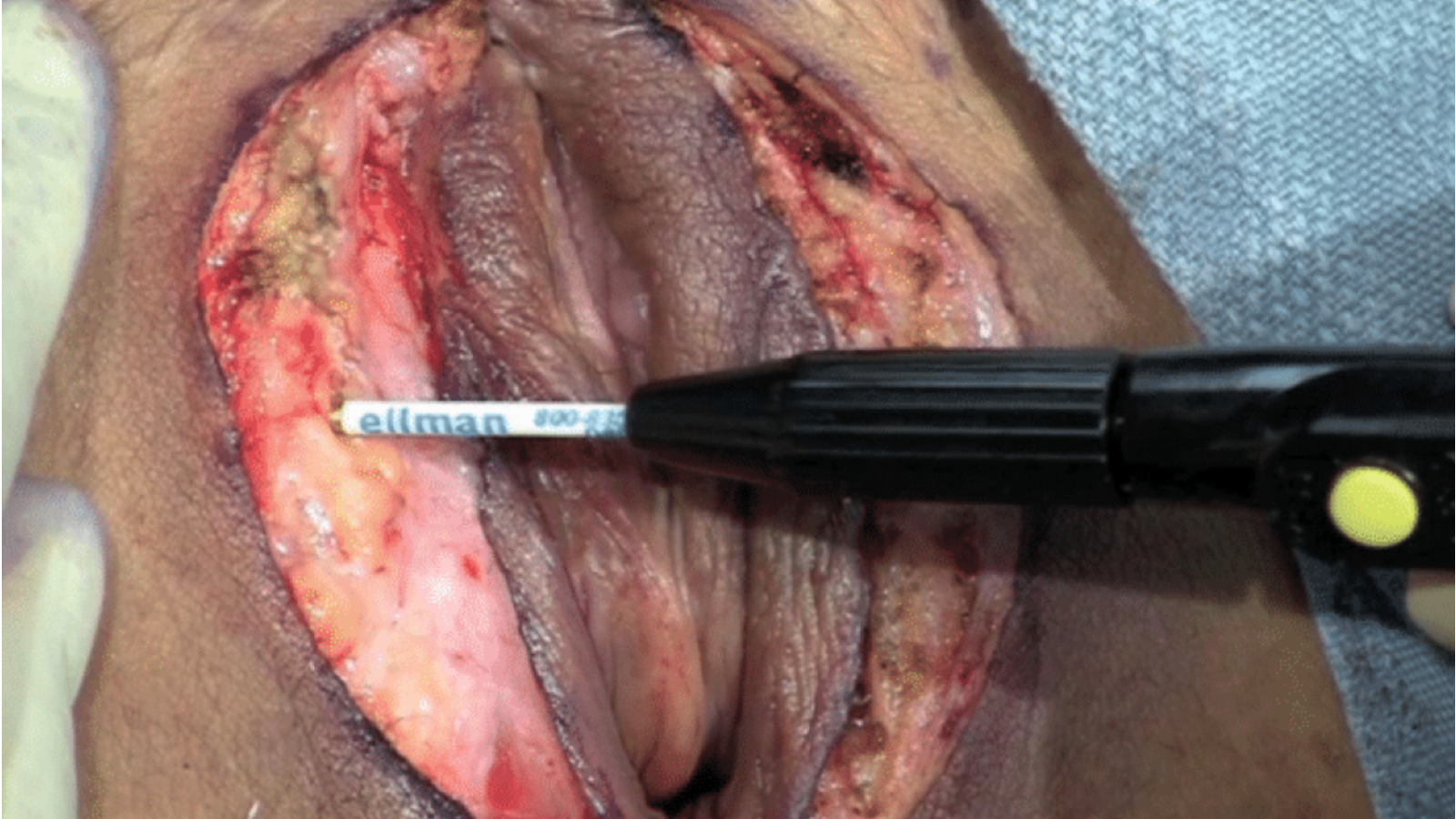 Labia Majoraplasty with Radiofrequency Feathering