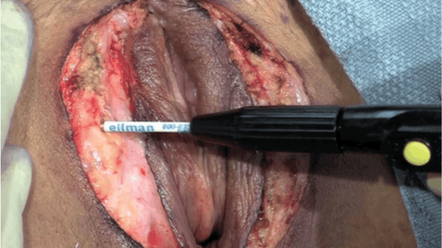 Labia Majoraplasty with Radiofrequency Feathering