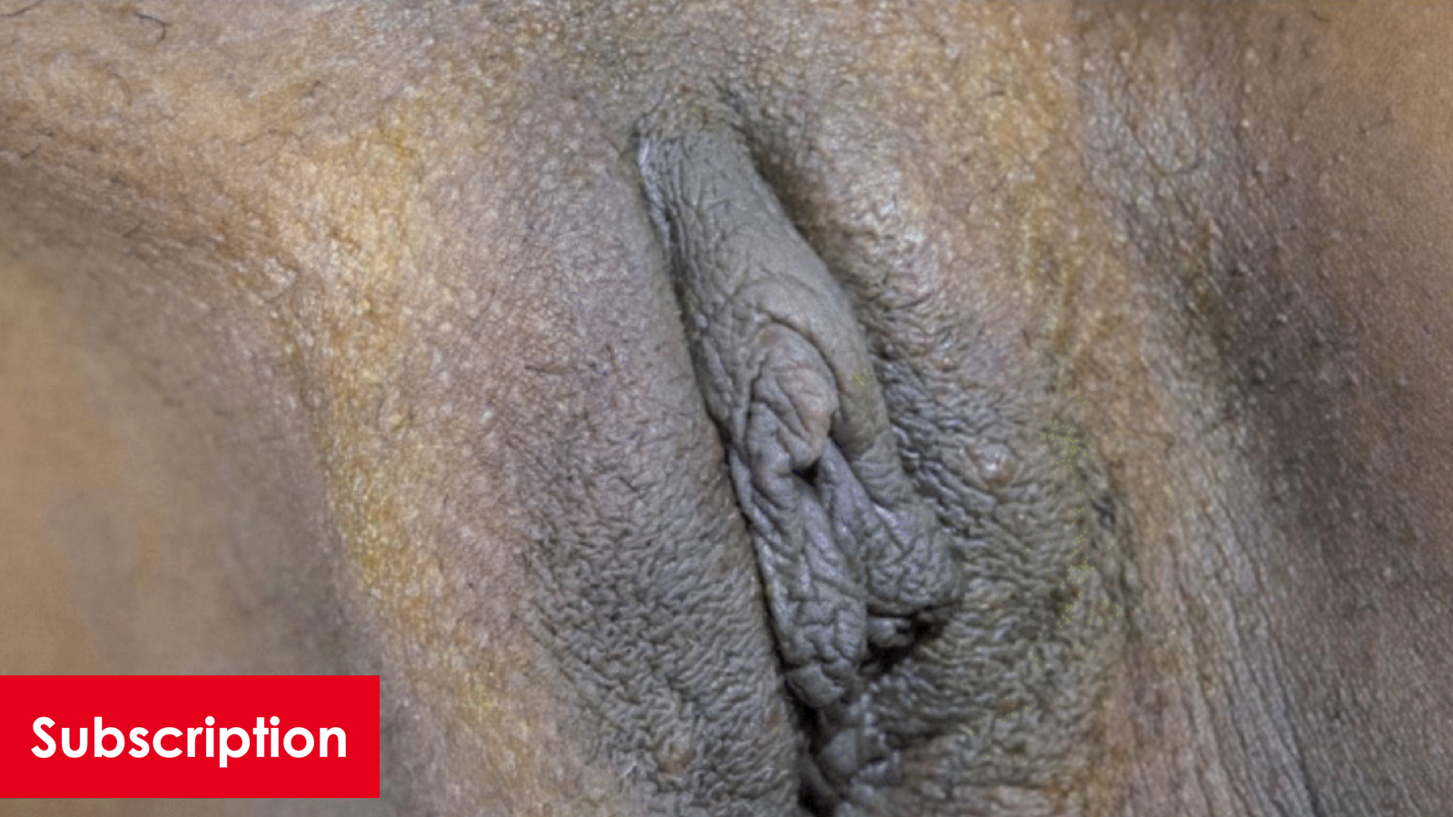 Vampire Wing Lift After Labiaplasty