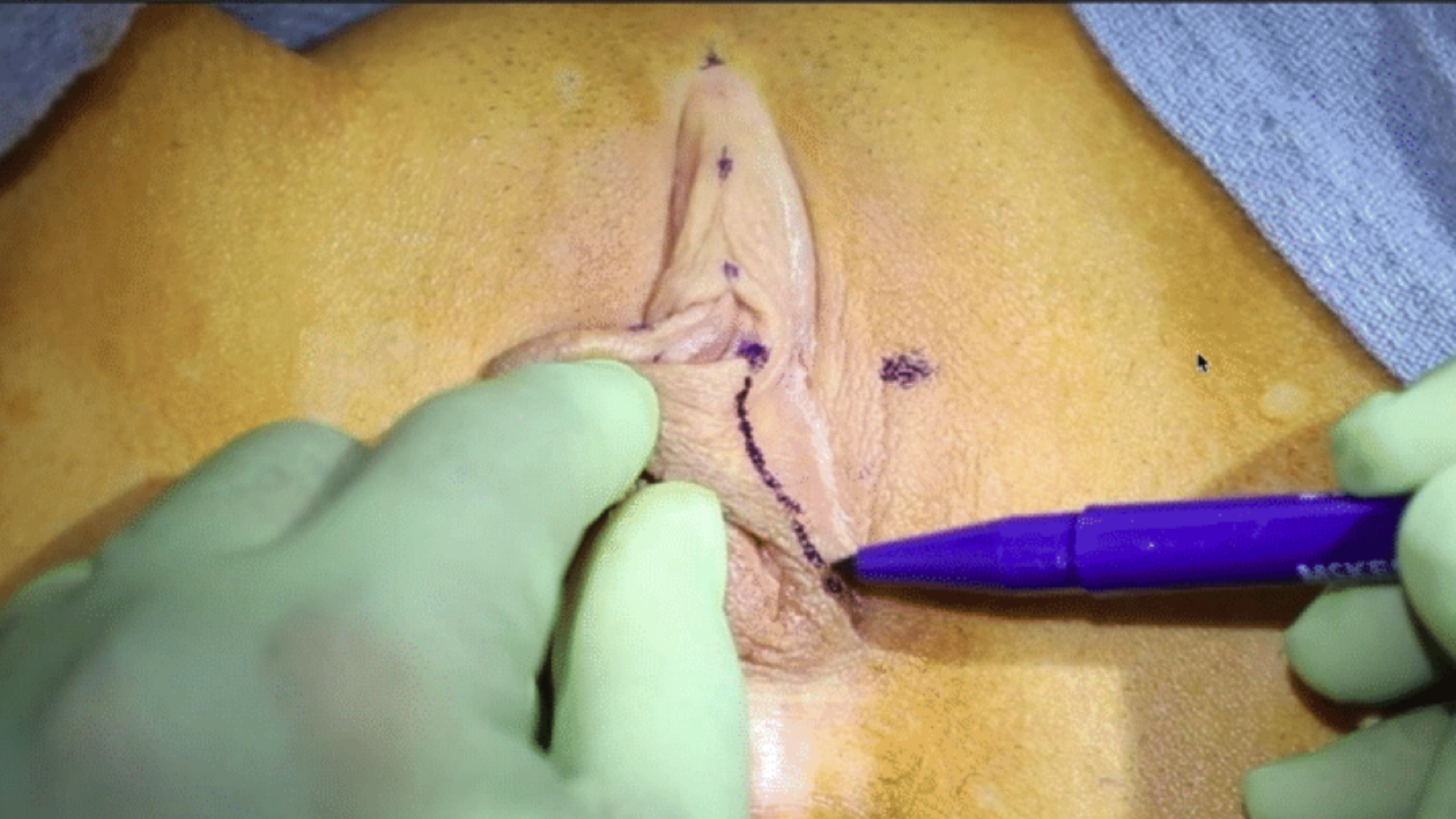 Labia Minoraplasty Anesthesia and Marking: Hybrid and Barbie Look