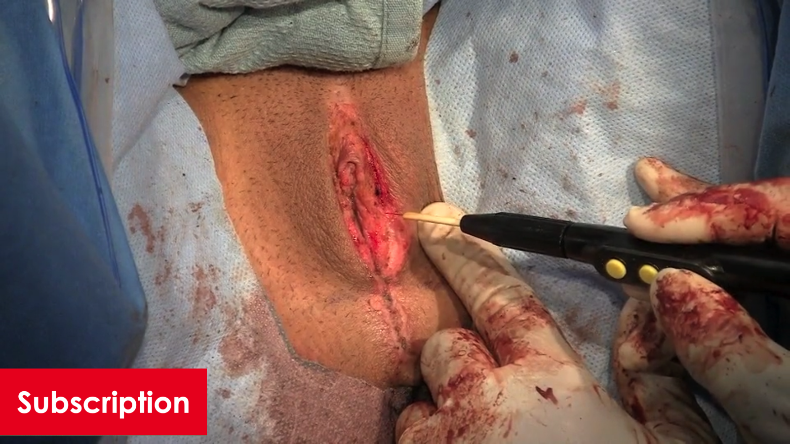 Vaginoplasty & Feathering Revision