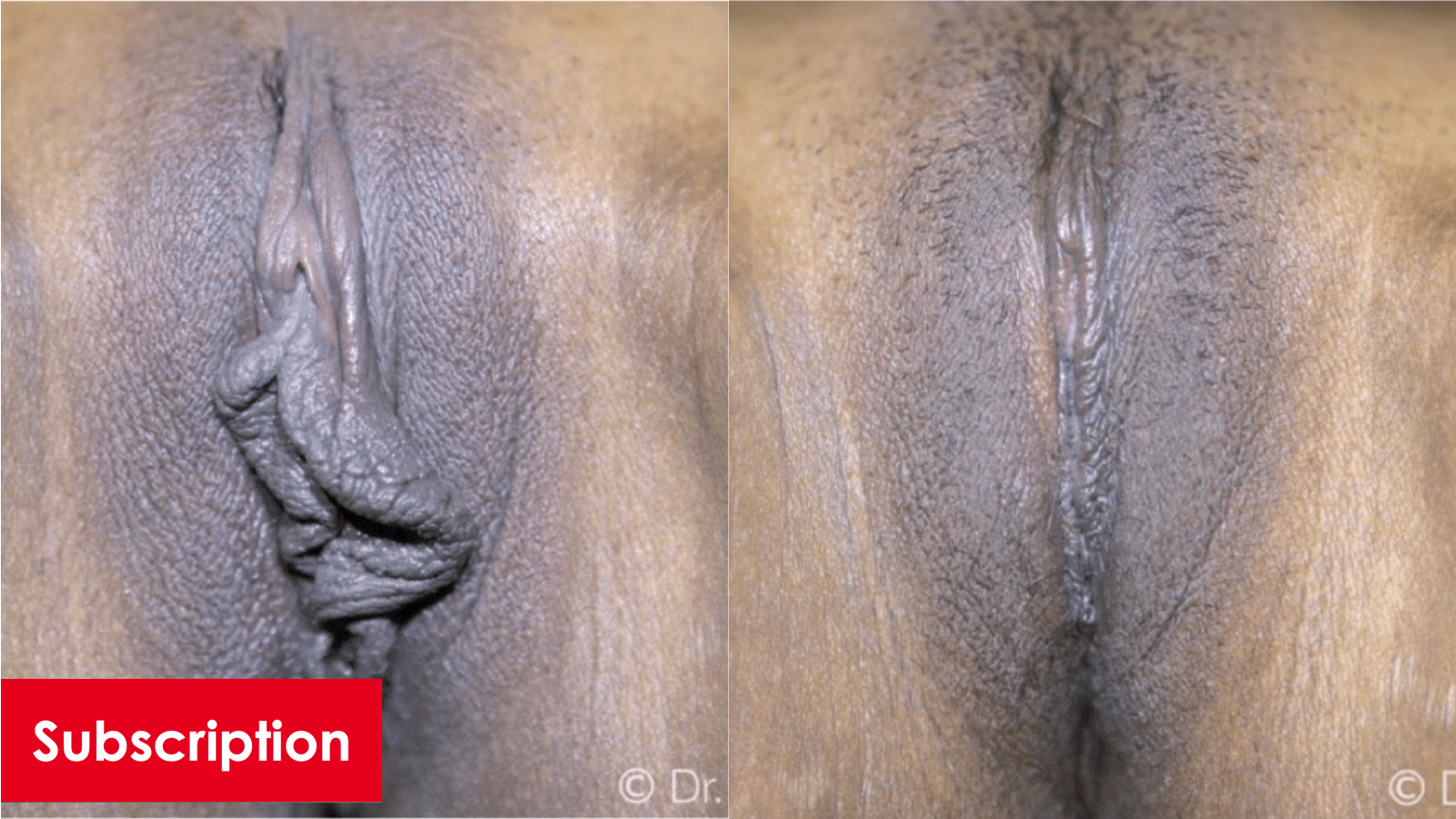 Barbie Look Labiaplasty with Medial and Lateral A Incisions