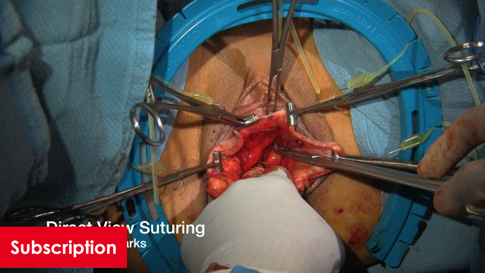 Vaginoplasty and Perineoplasty