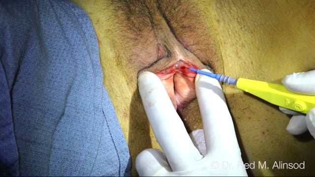 Clitoral Hood Release for Buried Clitoris