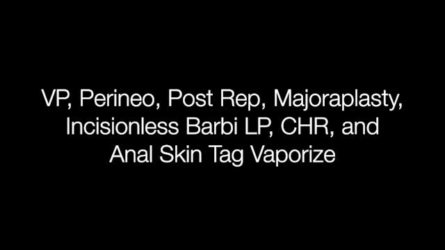 Perineo Post Rep Majoraplasty Incisionless Barbie LP, CHR, Anal Skin Tag Vaporiz