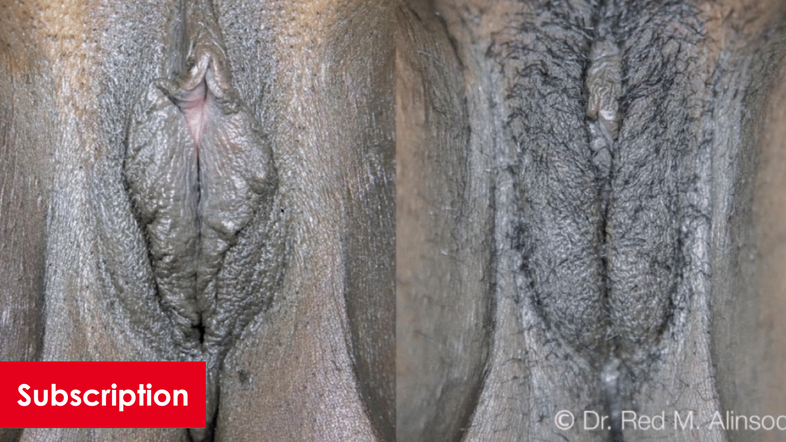 Perineoplasty and Dehiscence Repair