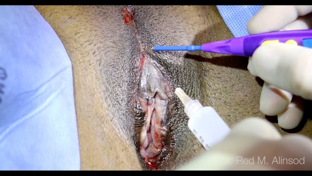 Live Narrated Feathering of Labial Edges