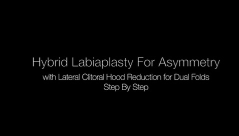 AIAVS Fellows Vid 262 Live Narrated Hybrid Labiaplasty for Sever Asymmetry w CHR