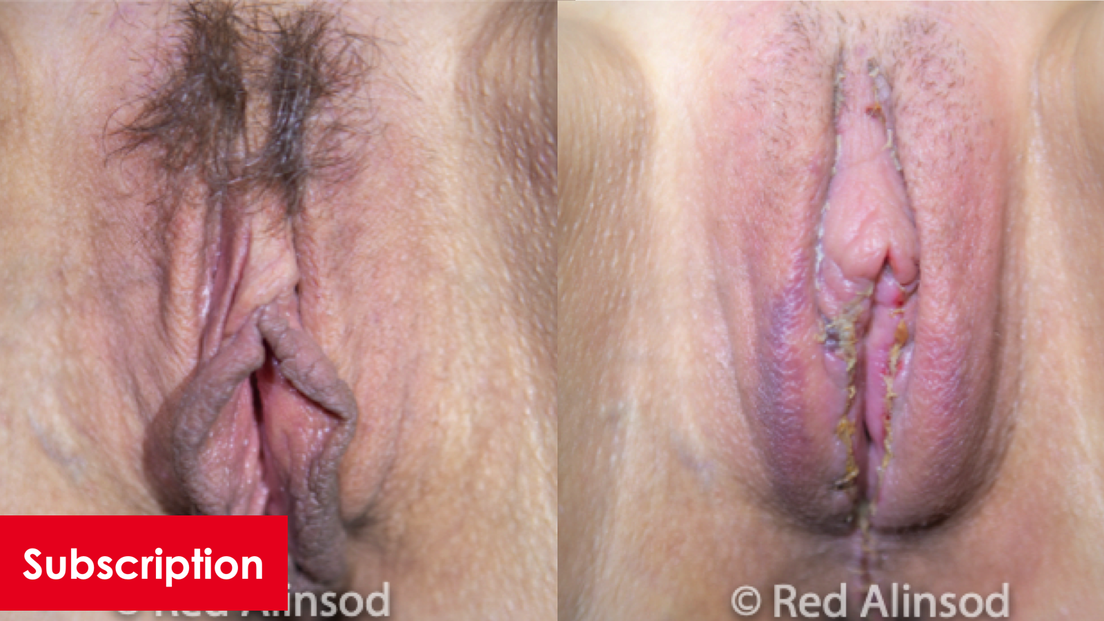 Perineoplasty, Hybrid Barbie Labiaplasty with Clitoral Hood Reduction