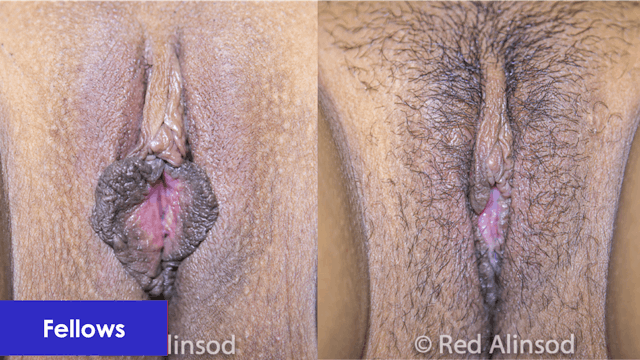Hybrid Labiaplasty