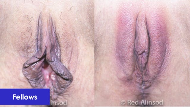 Hybrid Labiaplasty with Vampire Wing Lift ThermiVa