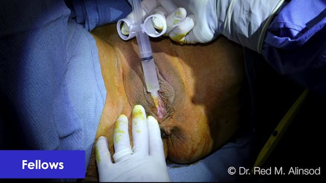 Labia Majoraplasty and Anal Skin Tag Removal by Radio Frequency Feathering