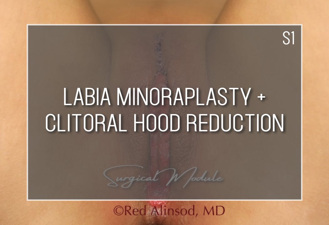 Module S1 Labia Minoraplasty wClitoral Hood $7500