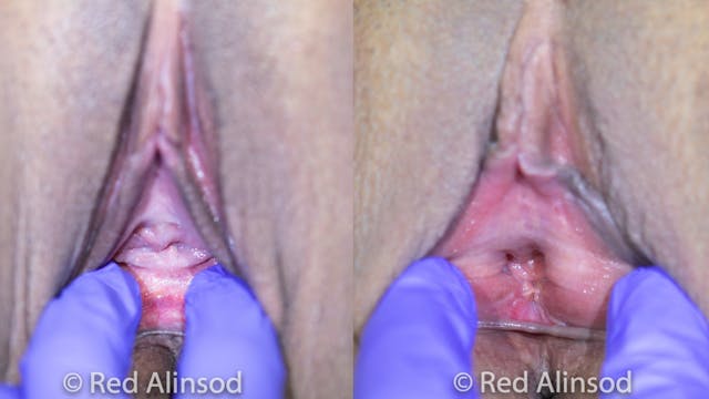 Hymenoplasty Pillar Technique with Po...