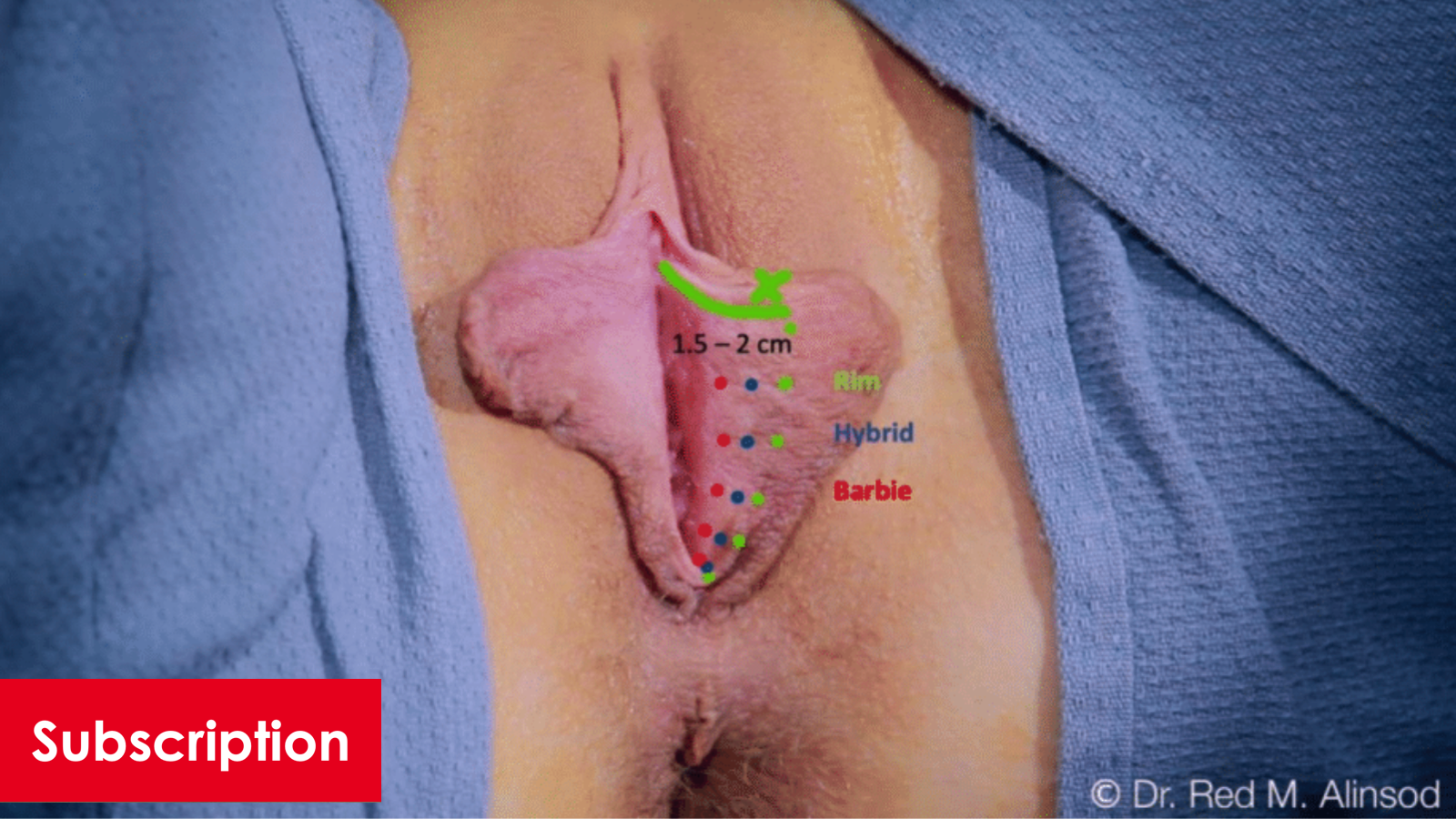 Rim Labiaplasty: The Basics