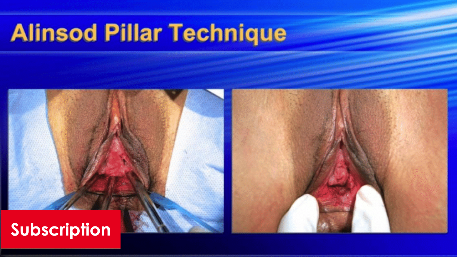 Hymenoplasty Lecture