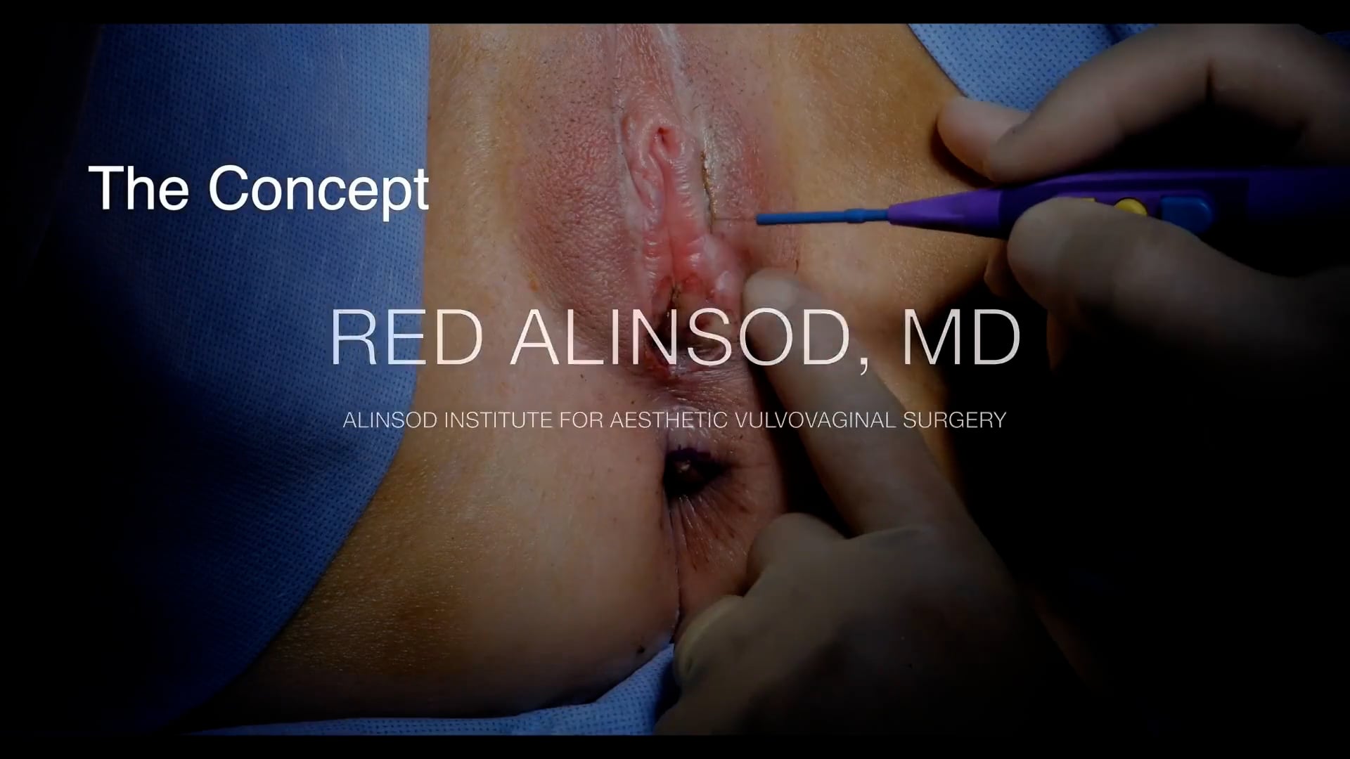 Técnica de Alinsod – Reconstrucción de Labios Menores en Ausencia de Labios