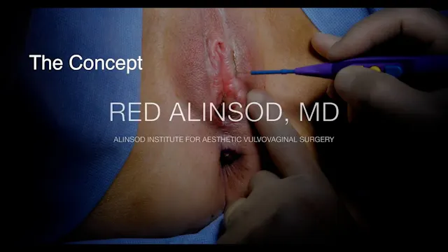 Técnica de Alinsod – Reconstrucción d...