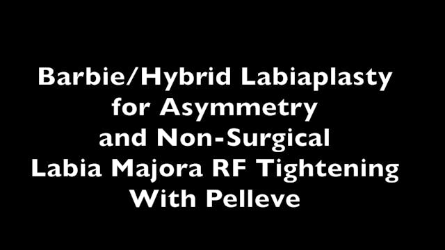 Alinsod 2C Hybrid Labiaplasty for Asymmetry & Majora RF Long