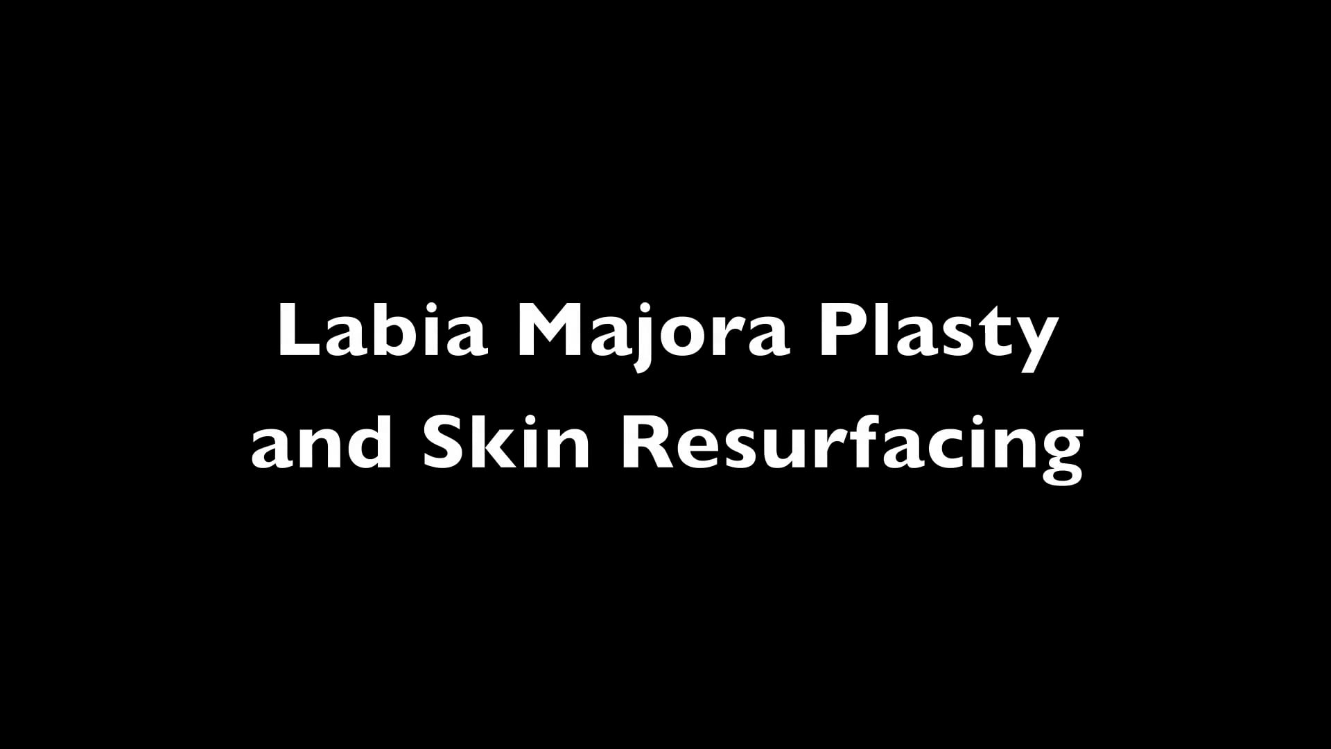 Labioplastia de Labios Mayores con Feathering por Radiofrecuencia