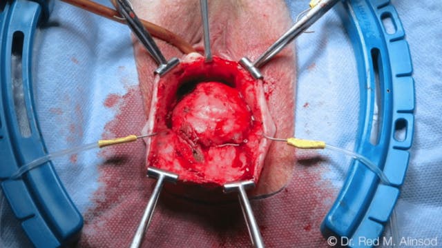 TOT, Anterior Repair with Dermis, and Transvaginal Uterine Suspension