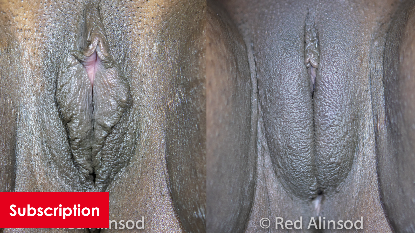 Barbie Labiaplasty. CHR, Perineoplasty, Excision of AST, VWL, Mons Augmentation