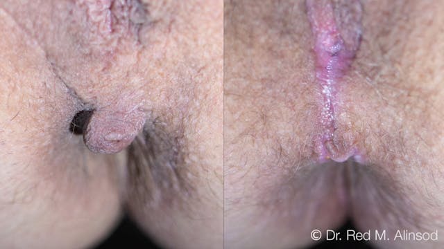 LNS9 Live Narrated RF Feathering of External Anal Skin Tags