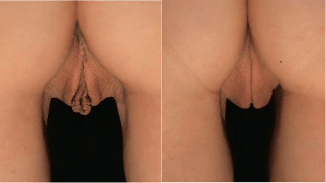 Combined Vaginoplasty and Labiaplasty with Clitoral Hood Reduction