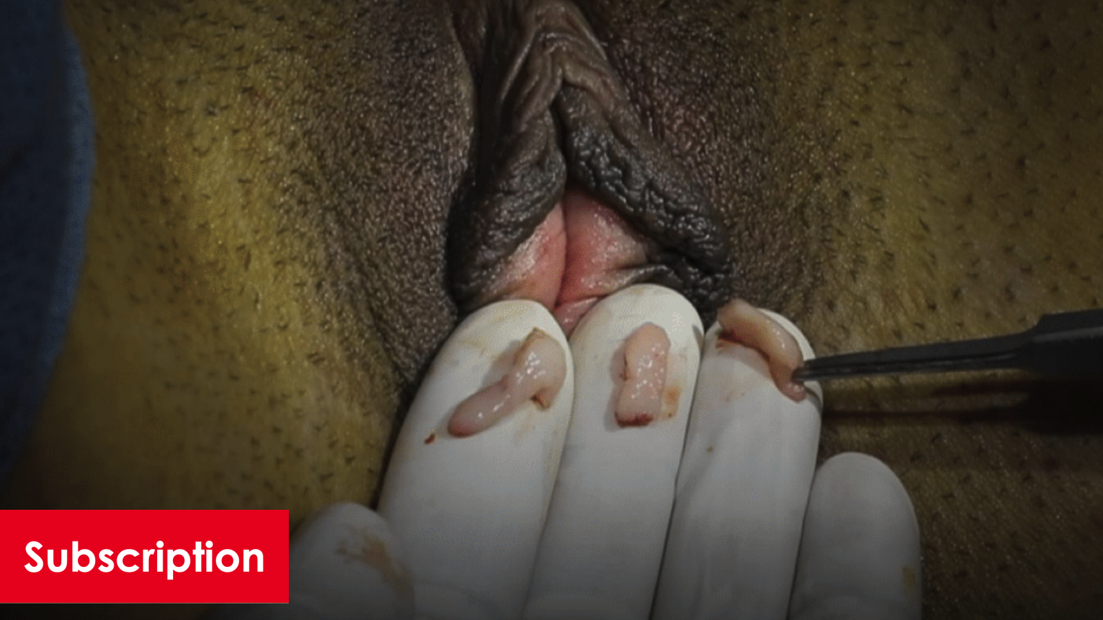 Excision of Hymneneal Remnants