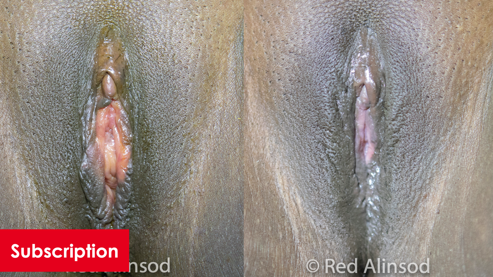 Cliteropexy, Clitoral Hood Coverage, and O-Shot