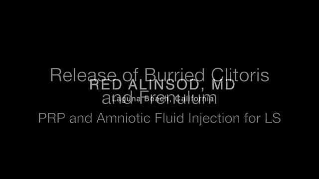 3 AIAVS Fellows Video 24, Release of Buried Clitoris and Frenulum, PRP and Amniotic Fluid Injection