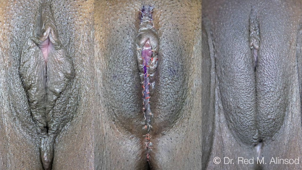 SHORTS: LNNS4 Large Volume Vampire Wing Lift for ESAG 2021