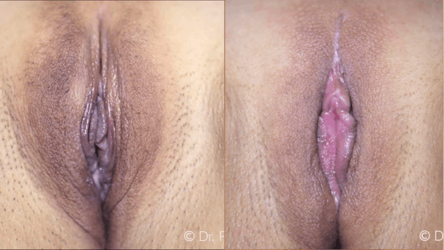 #21 Final LMP with FPR, VCHR, Labia Minora Feathering, and O-Shot Short Version 