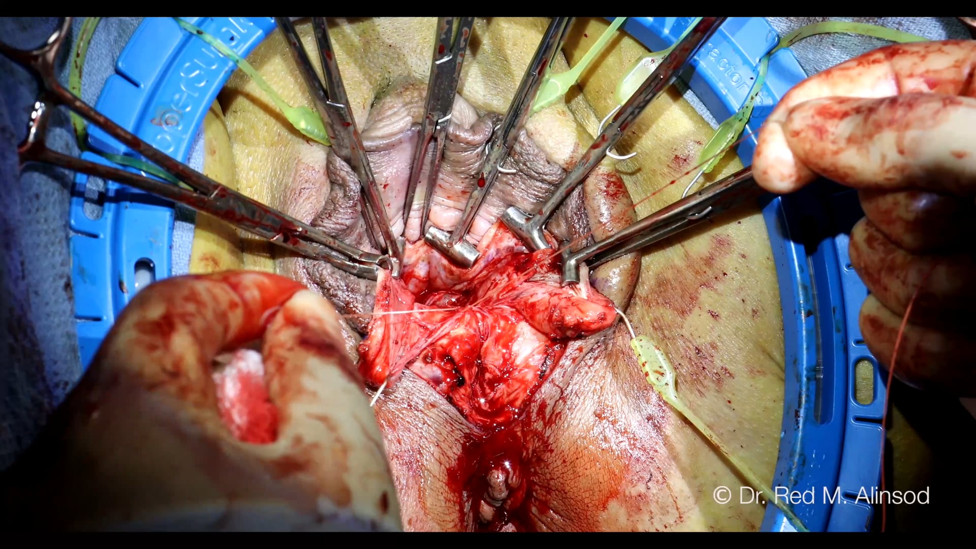 #35 The Unified Approach to Vaginoplasty and Labiaplasty Short 20 Min