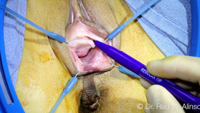 SHORTS: AIAVS Video 72, Live Narrated Hymenoplasty Pillar Technique (1)