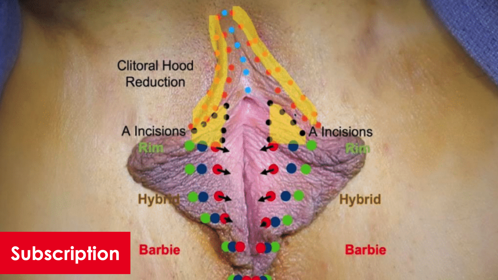 Alinsod Labiaplasty Technique: Barbie Goes International - Short