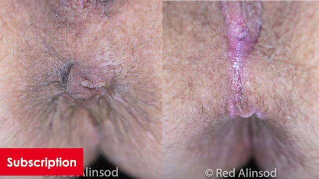 Management of External Anal Skin Tags...