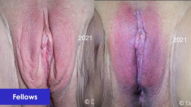 Labia Majoraplasty, TherniVa, and O-Shot