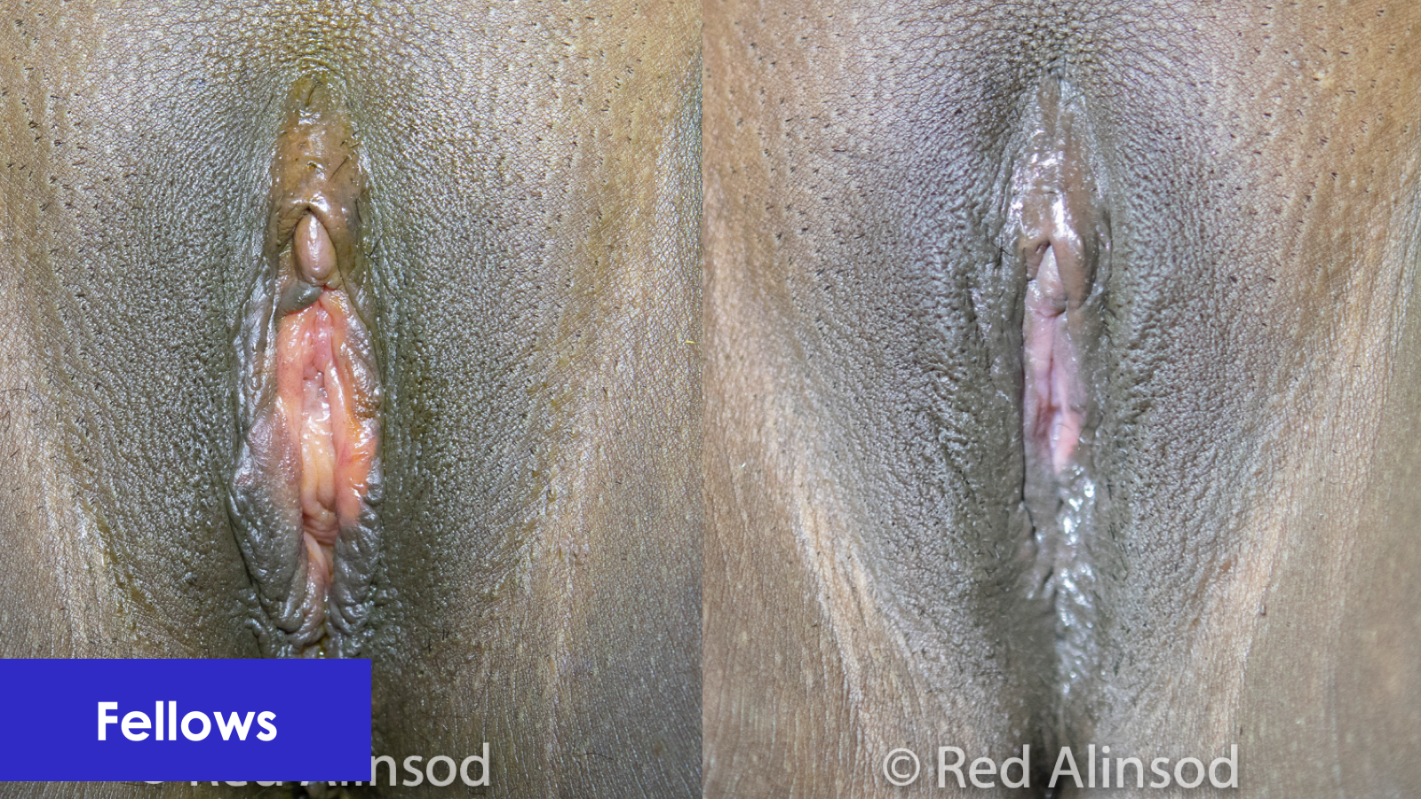 Clitoroplexy, Clitoral Hood Coverage, and O-Shot