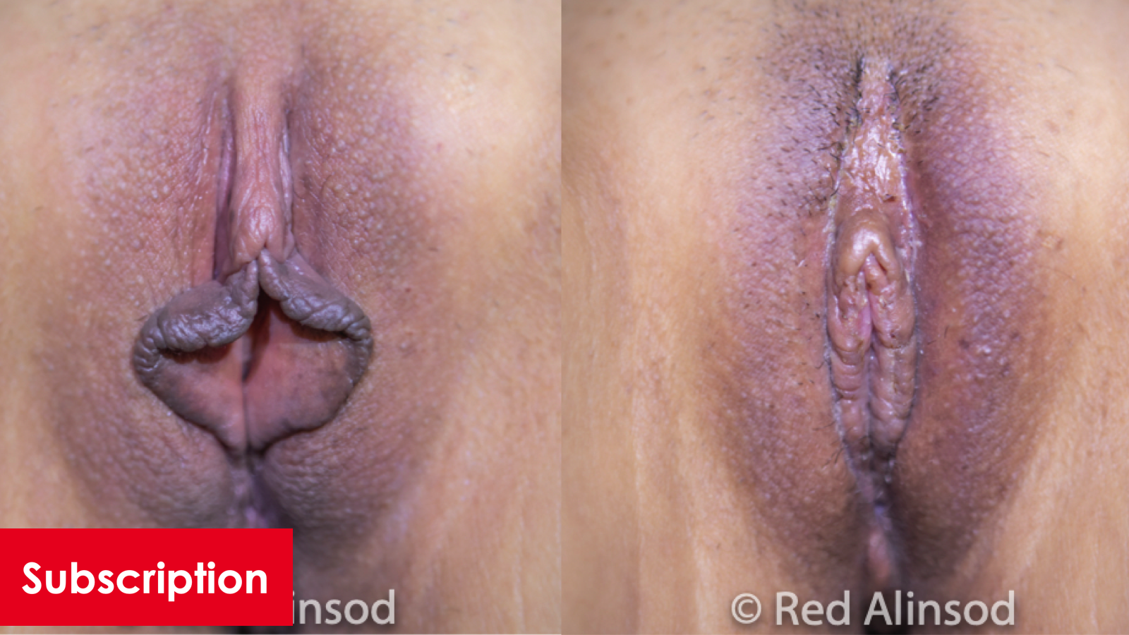 Perineal Bx, Labia Majoraplasty, Hybrid Labiaplasty, CHR, O-Shot, and PRP