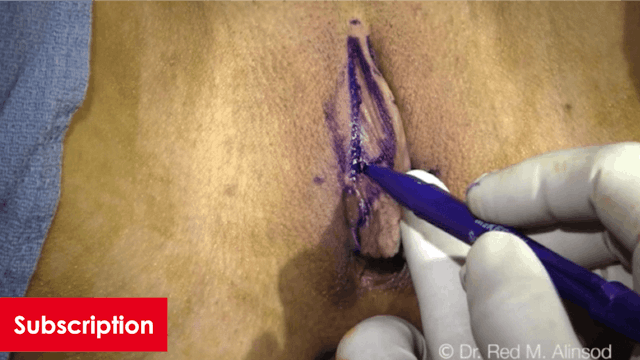 Clitoral Hood Reduction: Lateral and Vertical Approaches