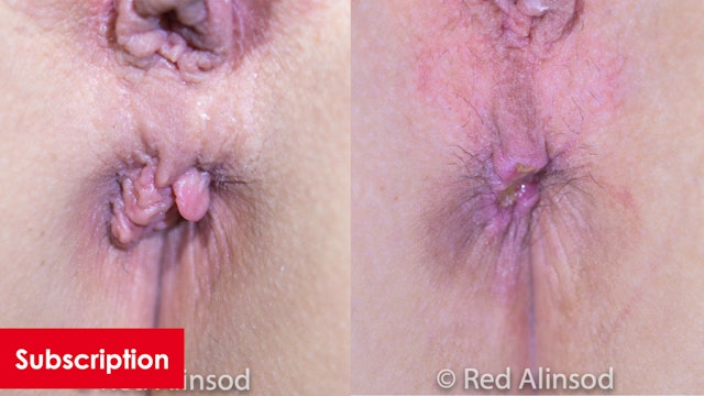 Radiofrequency Feathering of External Anal Skin Tags