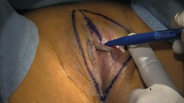 Labia Majoraplasty Anesthesia and Marking