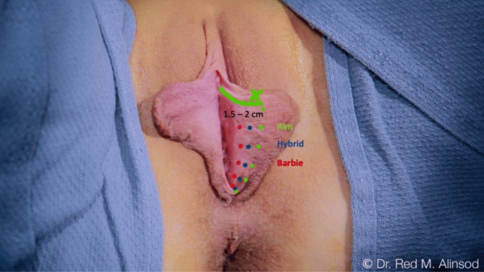 Rim Labiaplasty: The Basics