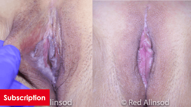 Labia Majoraplasty Fat Pad Removal, V...