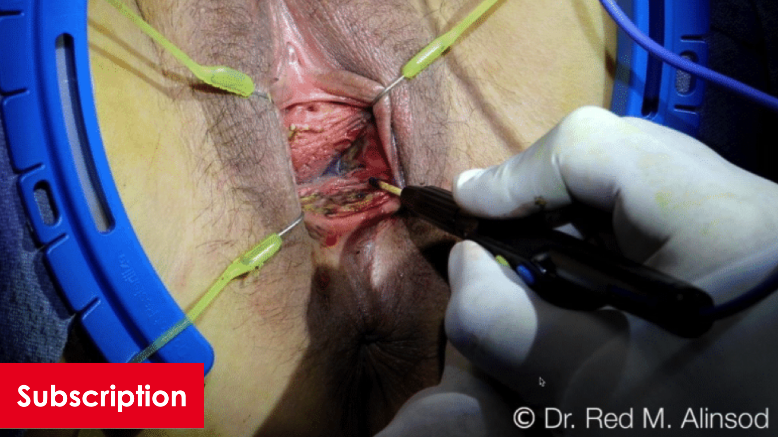 Radiofrequency Vaporization of Hymeneal Remnants for Dyspareunia