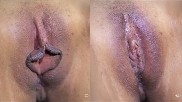 Perineal Bx, Labia Majoraplasty, Hybrid Labiaplasty, CHR, O-Shot, and PRP
