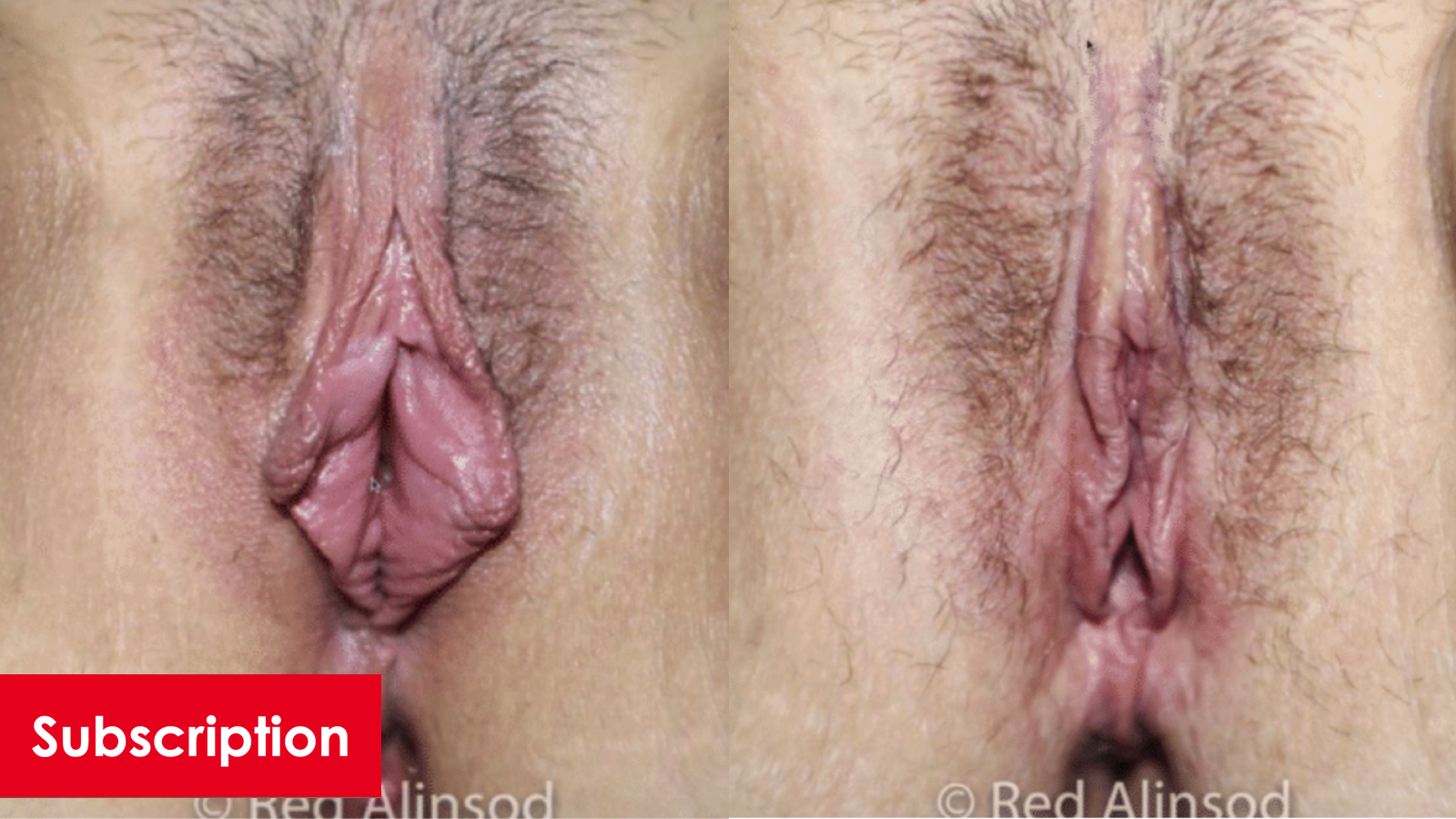 Hybrid Labiplasty, Clitoral Hood Reduction, and Anal Skin Tag Removal