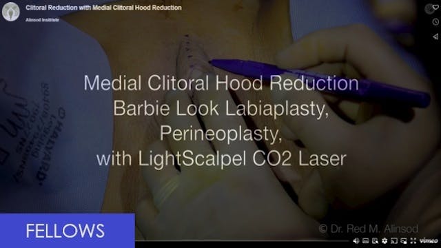 Clitoral reduction w medial clitoral hood reduction - full version