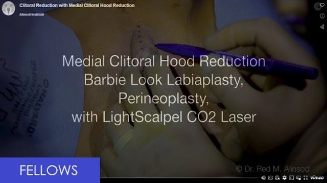 Clitoral reduction w medial clitoral ...
